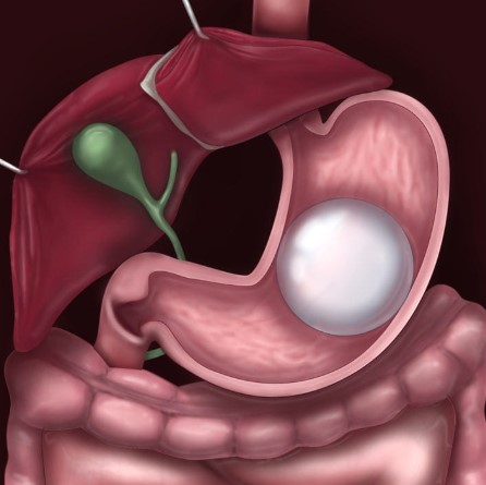  انواع بالون المعدة
