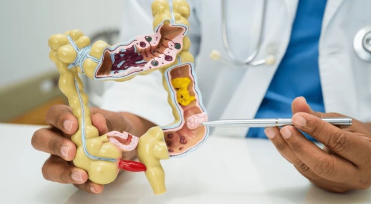 علاج القولون العصبي | دليل شامل للأسباب والأعراض والعلاج