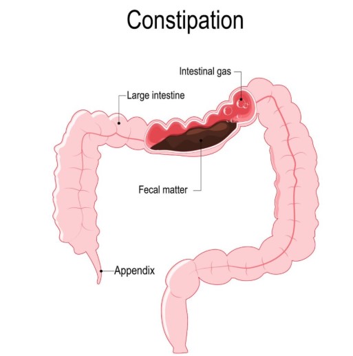 علاج الإمساك المزمن