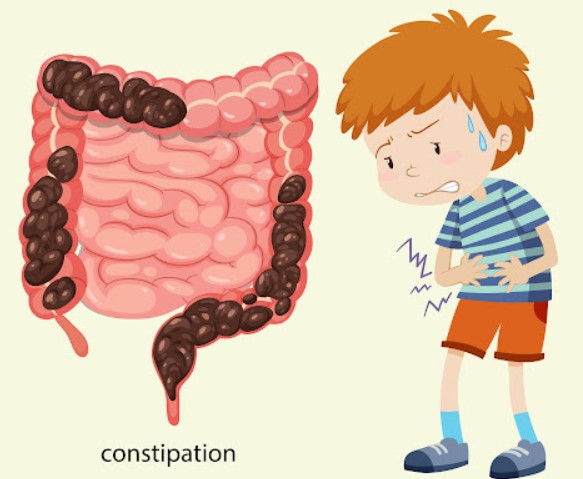 علاج الإمساك المزمن