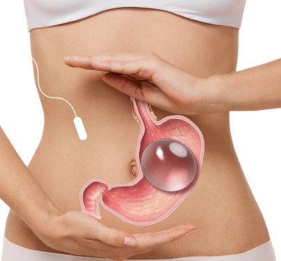 عملية بالون المعدة