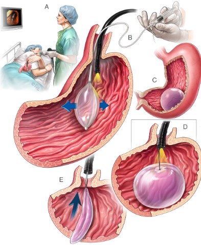 افضل دكتور بالون معدة في الكويت