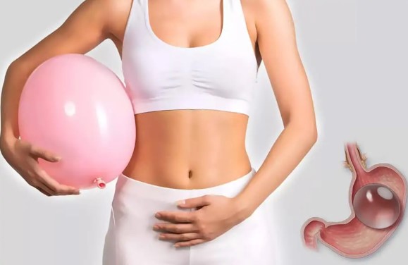 تجربتي مع بالون المعدة للتخسيس 