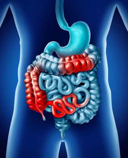 أسباب القولون العصبي