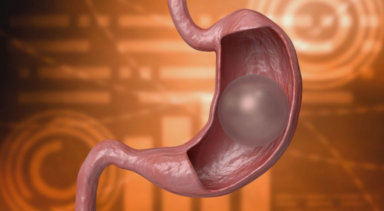 عملية بالون المعدة