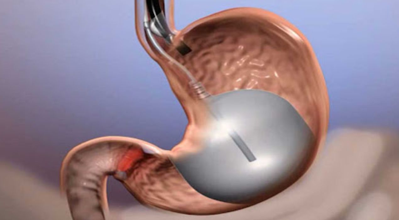 اليك اشهر انواع بالون المعدة في الكويت…اختار ما يناسبك