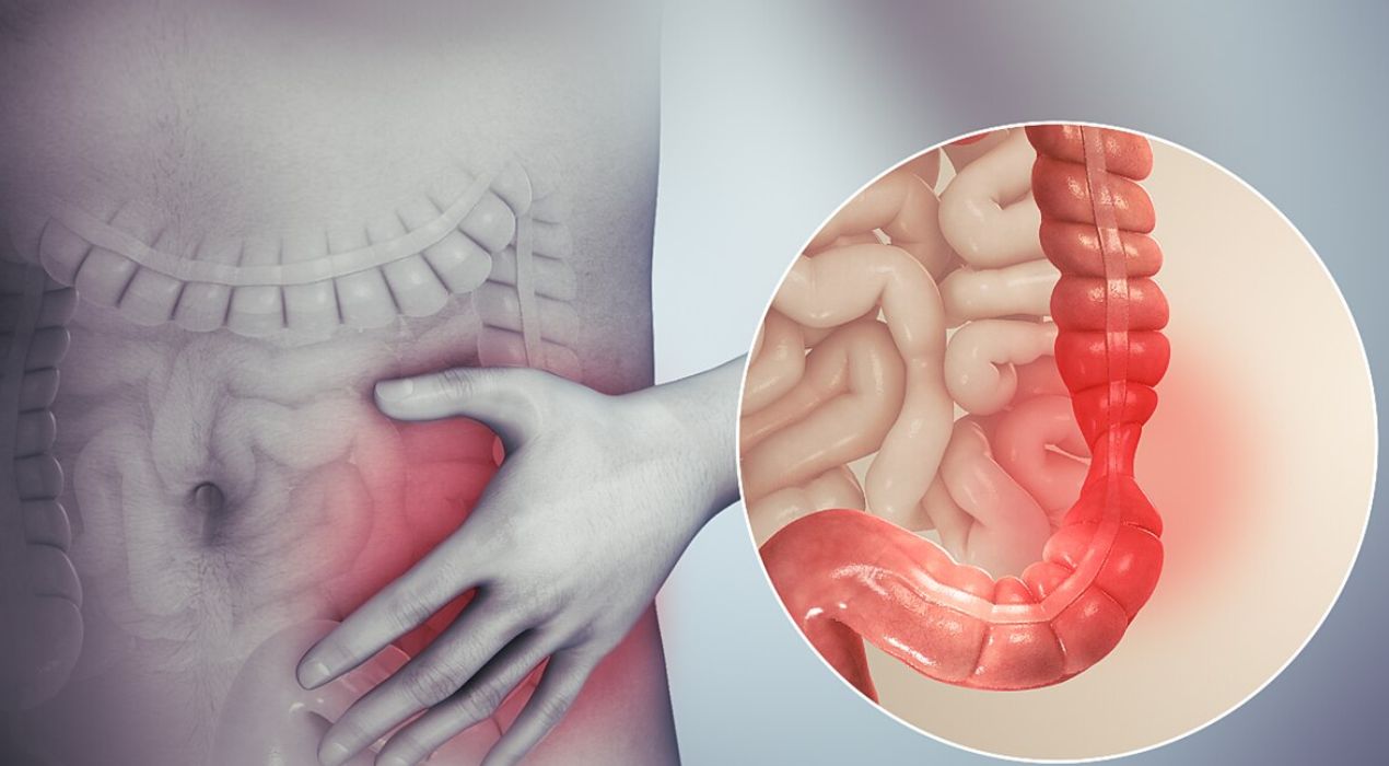 أسباب القولون العصبي | دليل شامل لفهم المتلازمة وأسبابها