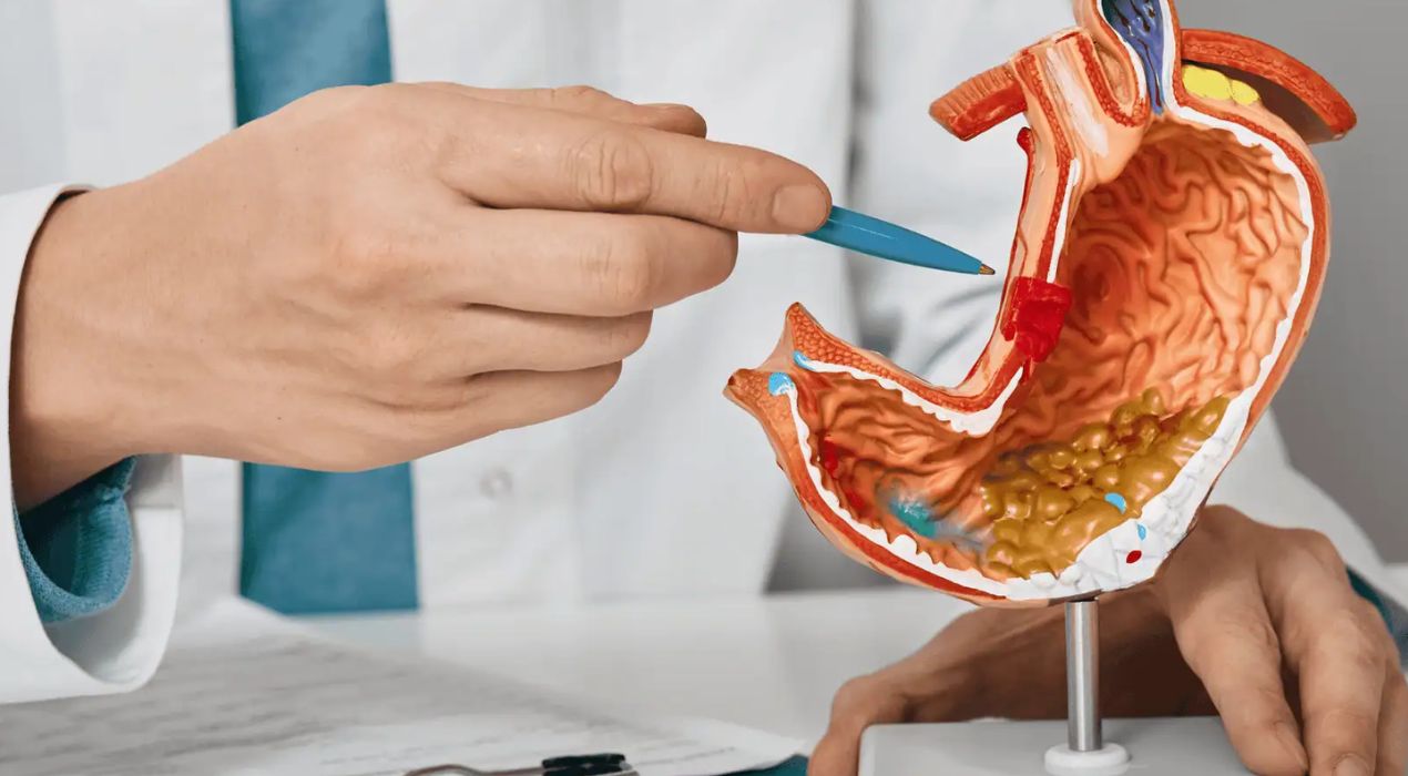 تعرف علي أعراض قرحة المعدة والقولون بالتفصيل وطرق العلاج 2026