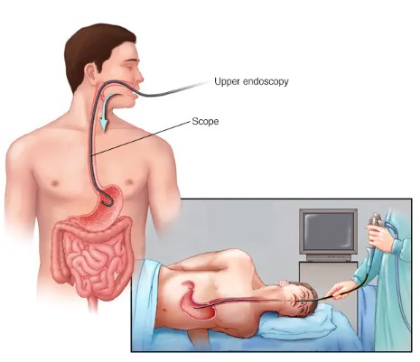 علاج ارتجاع المرئ 