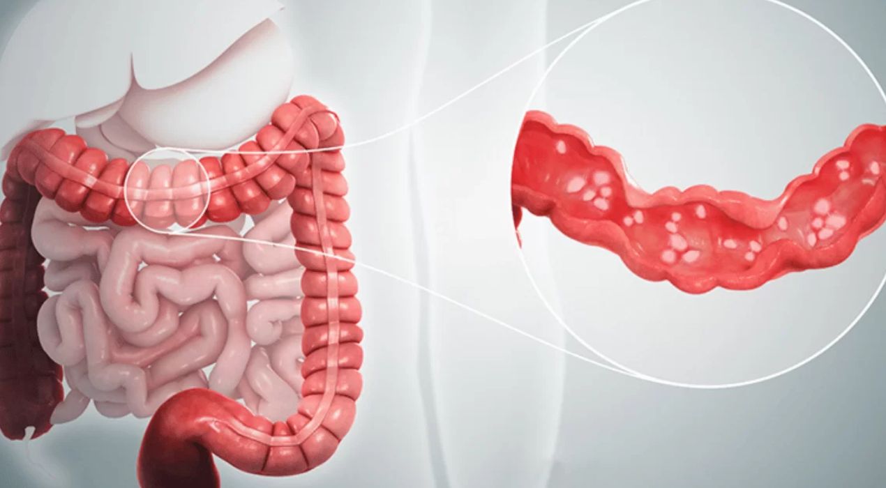 تعرف على اسباب التهاب القولون وأنواعه وطرق العلاج 2026