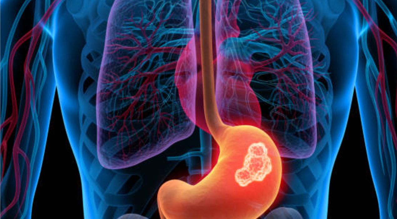 دليلك حول اهم اسباب سرطان المعدة وابرز اعراضه وطرق علاجه