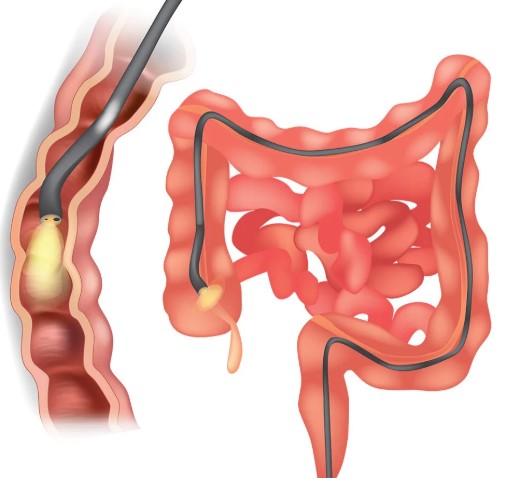 التحضير قبل منظار القولون 