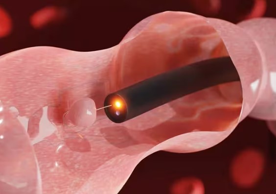 انواع زوائد القولون