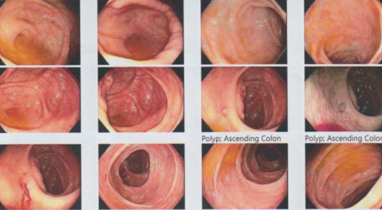 دليلك الكامل عن انواع زوائد القولون وكيفية تشخيصها 2026