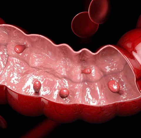 انواع زوائد القولون