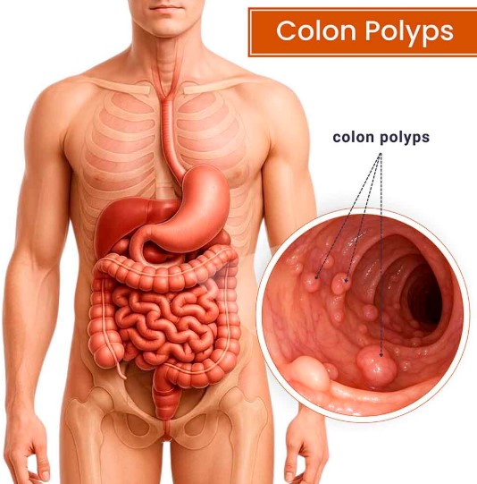 زوائد القولون