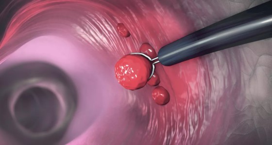 زوائد القولون