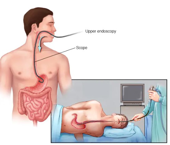 هل ارتجاع المرئ يسبب الوفاه