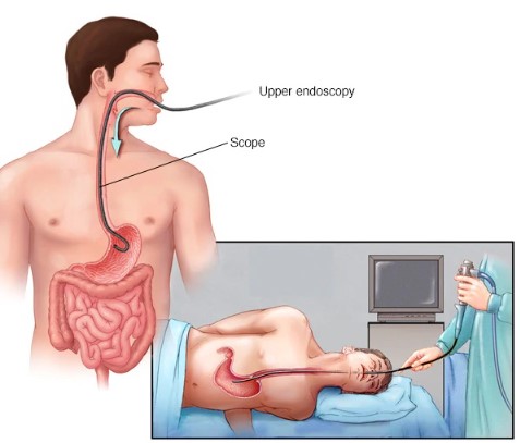 فتق الحجاب الحاجز
