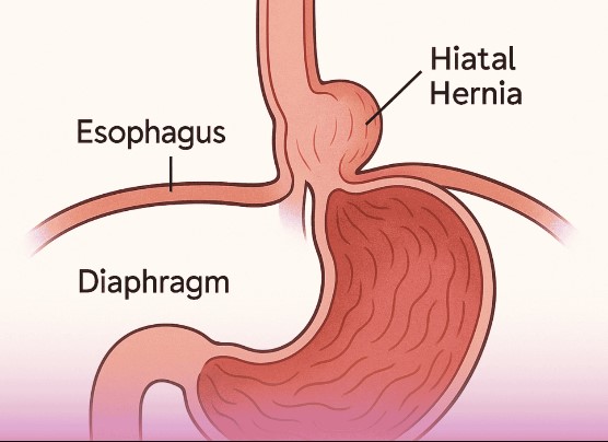 فتق الحجاب الحاجز