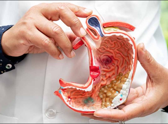 فتق الحجاب الحاجز