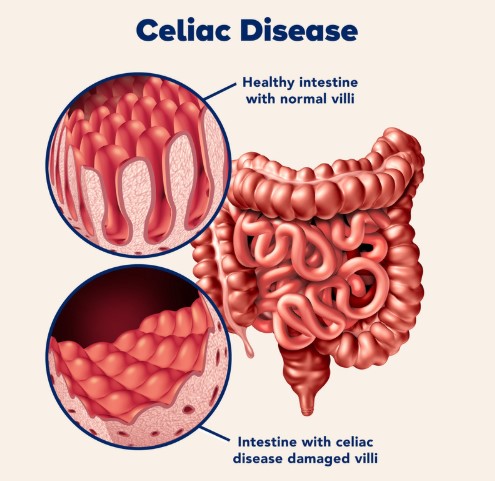 مرض السيلياك