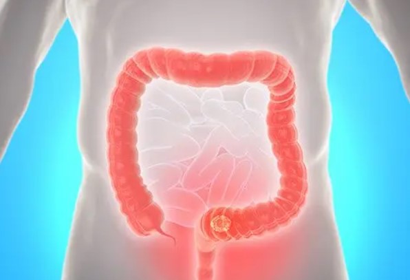  اسباب وجود دم في البراز 