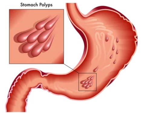 سلائل المعدة