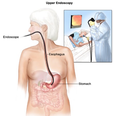 علاج نزيف المعدة