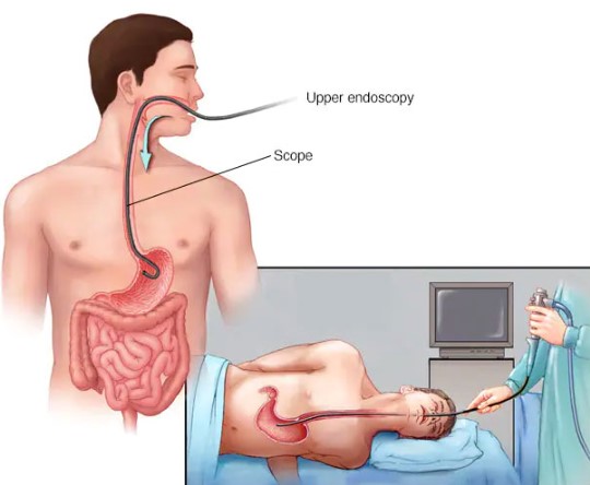 علاج نزيف المعدة