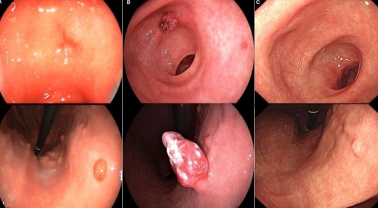 تعرف علي مفهوم لحمية المعدة (سلائل المعدة) وابرز اعراضها