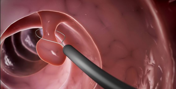 هل لحميات القولون سرطان