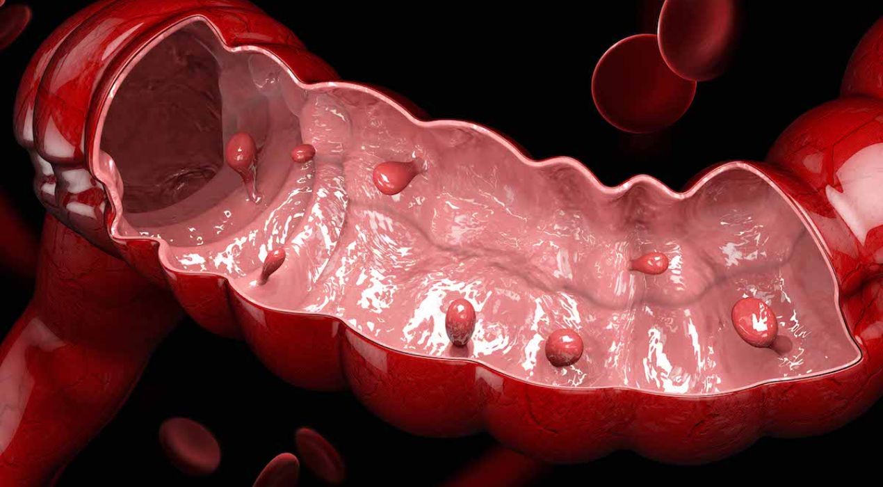 هل لحميات القولون سرطان ؟…اليك الاجابة من دكتور فهد الابراهيم