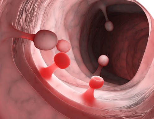 هل لحميات القولون سرطان