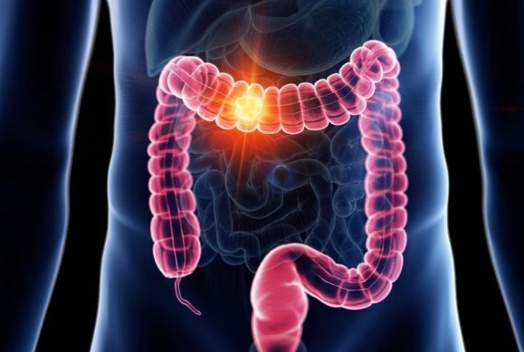  الوقاية من سرطان القولون