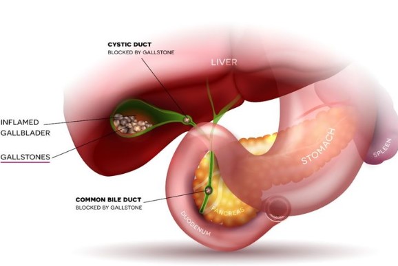 حصوات المرارة واعراضها
