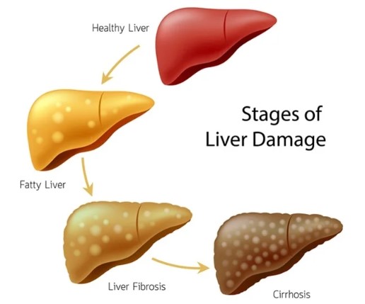 درجات تليف الكبد