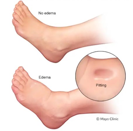 درجات تليف الكبد