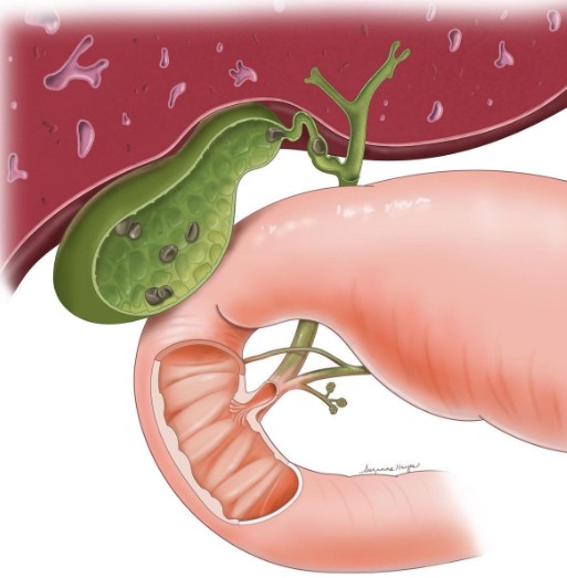 أسباب حصوات المرارة