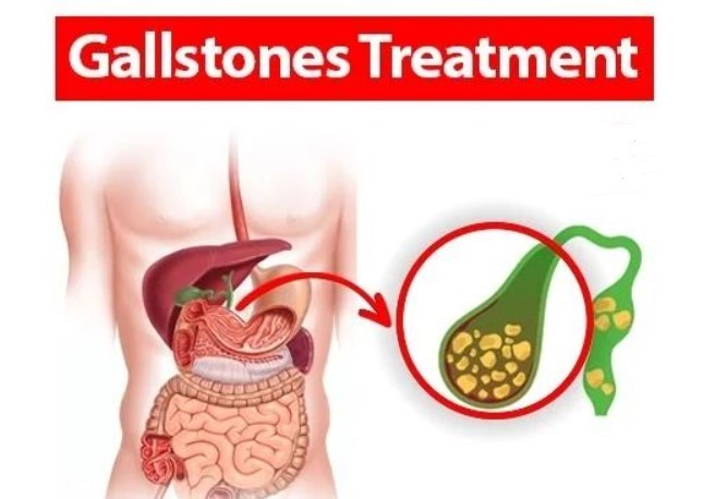 أسباب حصوات المرارة