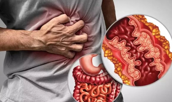 اعراض مرض كرونز