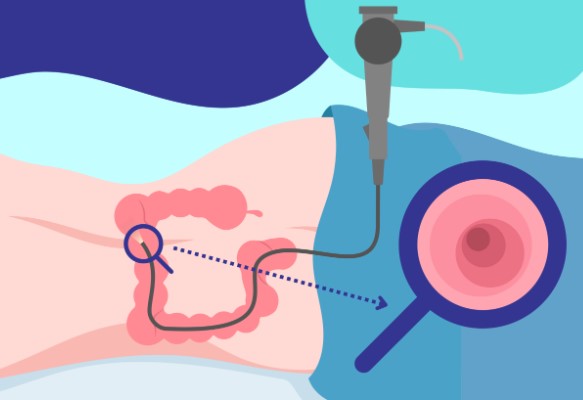 علاج مرض كرونز