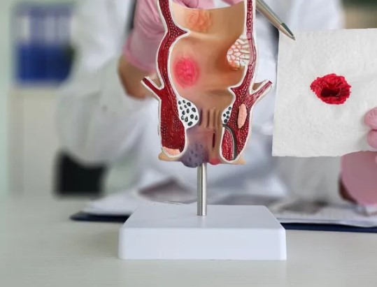 علاج نزيف الشرج