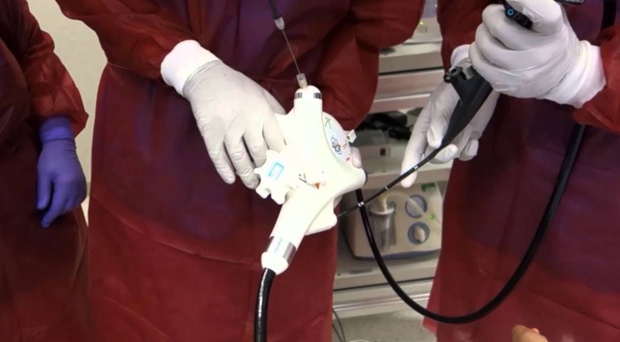 كل ما تود معرفته عن تقنية gerdx “عملية ارتجاع المرئ بدون جراحة”