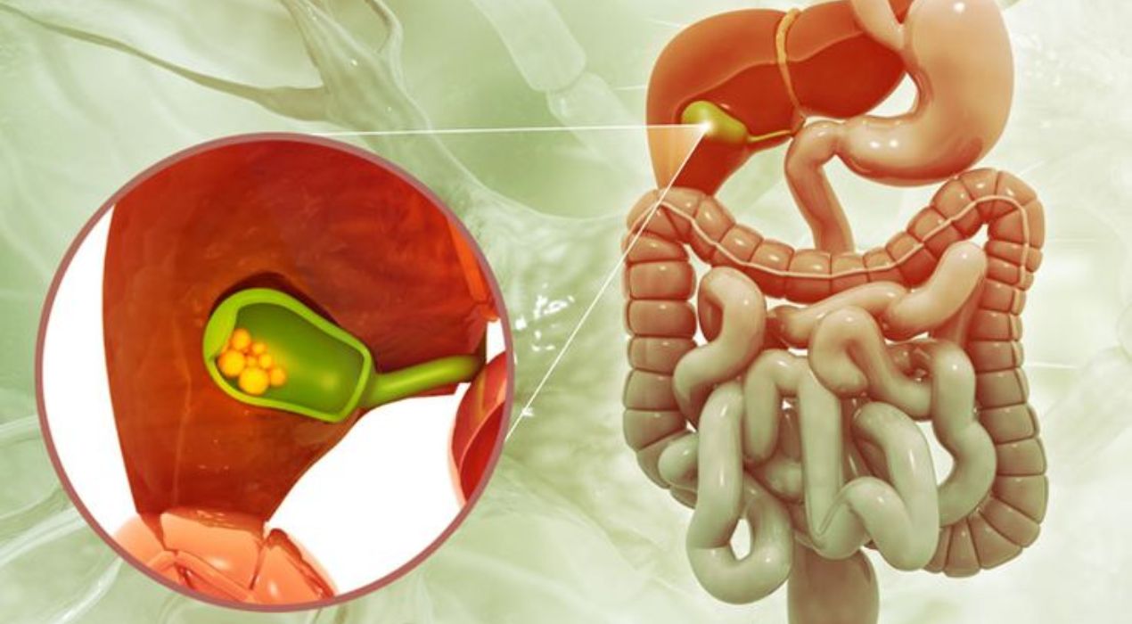 تعرف على أسباب حصوات المرارة وأهم الأعراض 2026 |دليلك الكامل