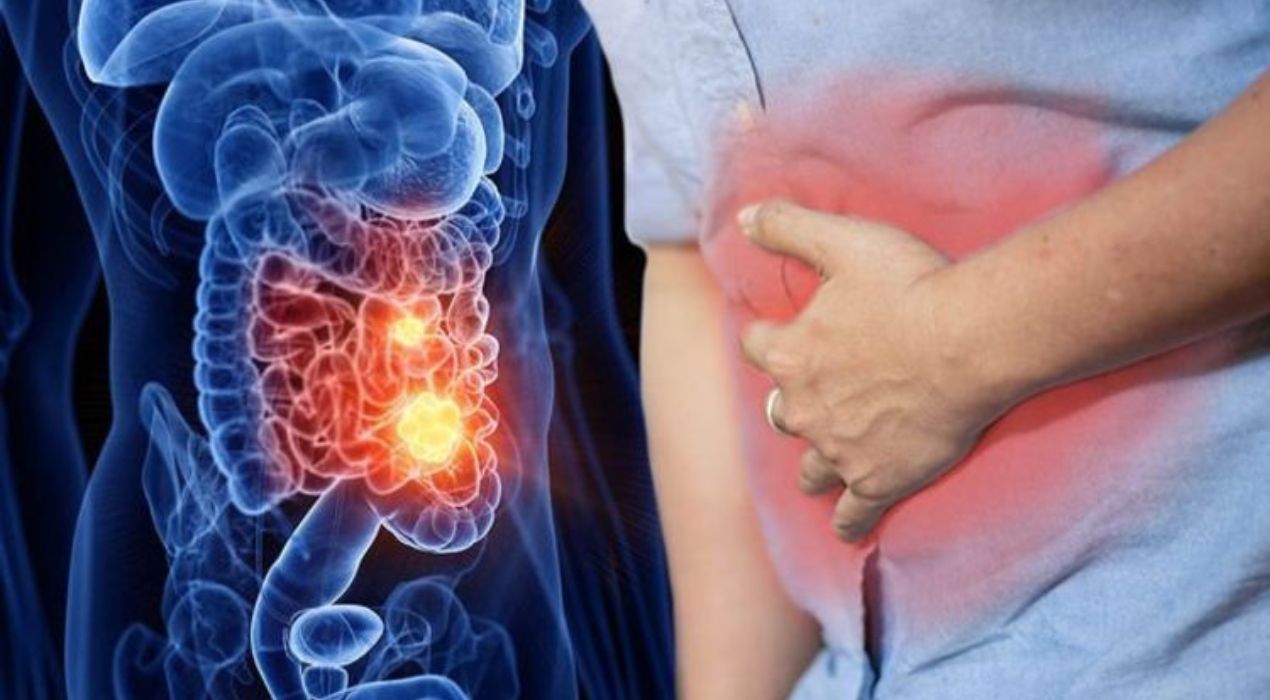 دليلك الشامل عن اعراض مرض كرونز وابرز اسبابه ومدي خطورته