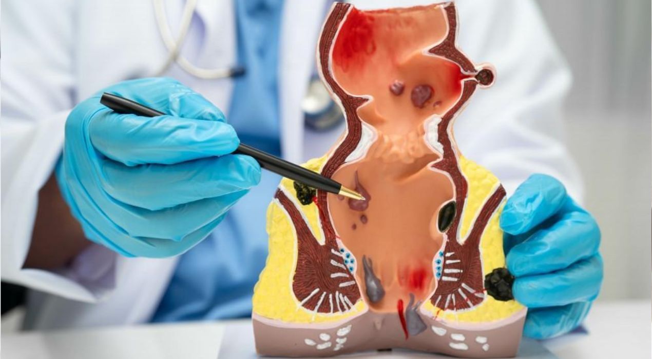 تعرف الآن على علاج نزيف الشرج وأهم النصائح لتخفيف الألم بسرعة