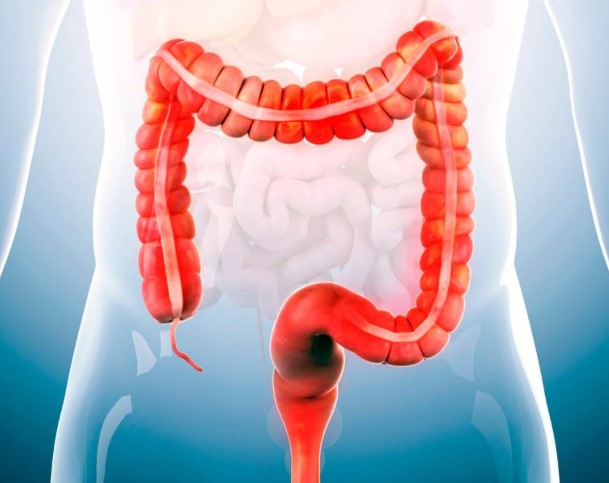 علاج انسداد الأمعاء